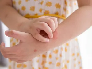 5 Mitos Eksim yang Masih Dipercaya, Ternyata Nggak Menular!