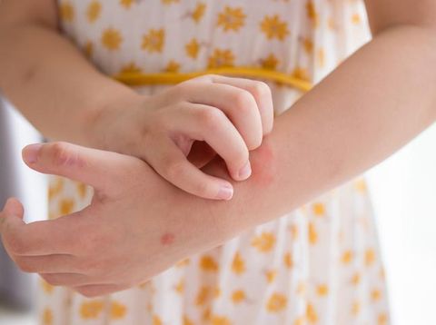 5 Mitos Eksim yang Masih Dipercaya, Ternyata Nggak Menular!