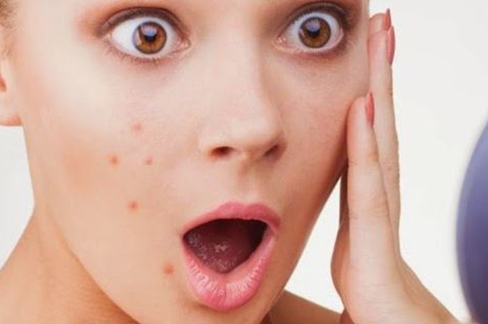 8 Cara Menghilangkan Jerawat di Pipi dengan Cepat, Bisa dalam Semalam?