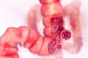 Kanker Usus Besar pada Usia...